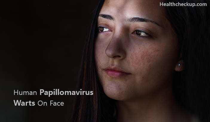 Human papillomavirus warts on face