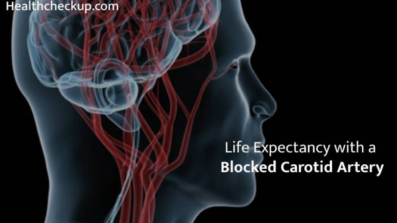 can you live with 100 blocked carotid artery