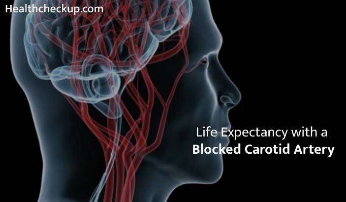How long can you live with a blocked carotid artery