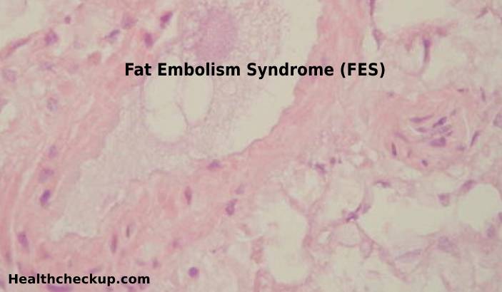 Fat Embolism Syndrome (FES)