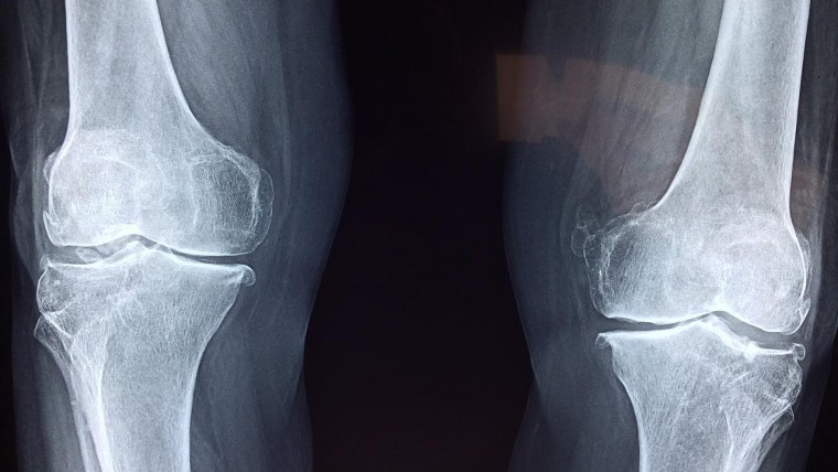 Do and don'ts after knee surgery