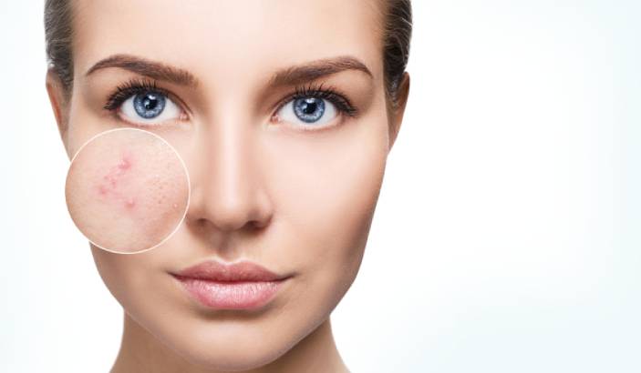 Experiencing Mild To Moderate Acne? Here Are 4 Treatment Options You Should Try