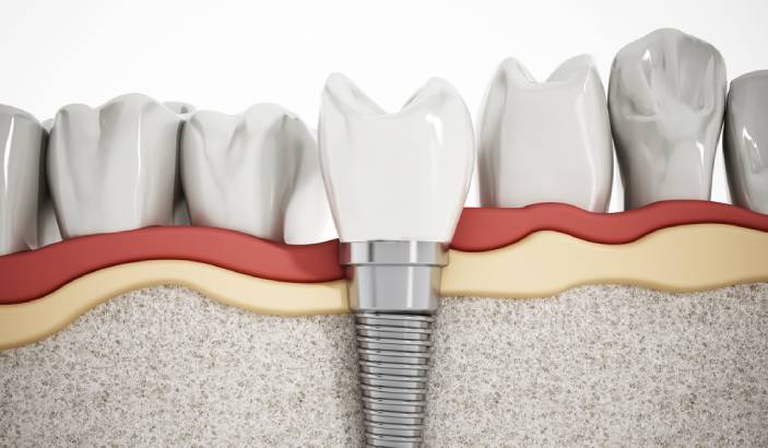 Are Dental Implants Permanent?