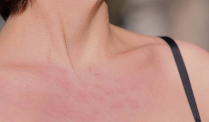 Is the redness on the chest a sign of chronic illness?