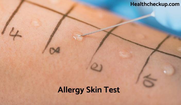 Allergy Skin Test - Purpose, Procedure & Results