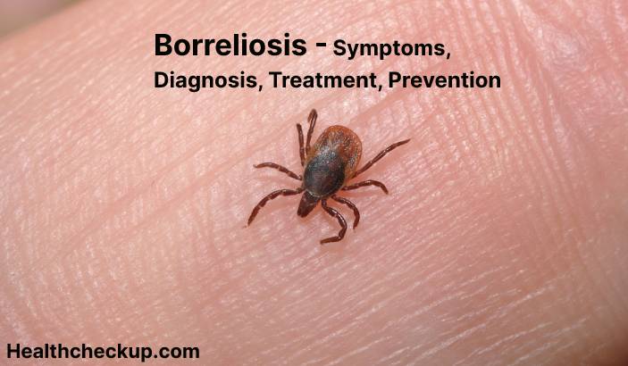 Borreliosis - Symptoms, Diagnosis, Treatment, Prevention