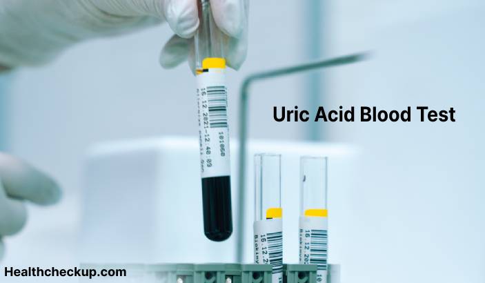 Uric Acid Blood Test - Purpose, Procedure, Normal Range