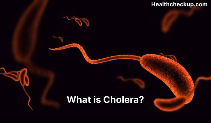 Cholera - Symptoms, Diagnosis, Treatment, Prevention