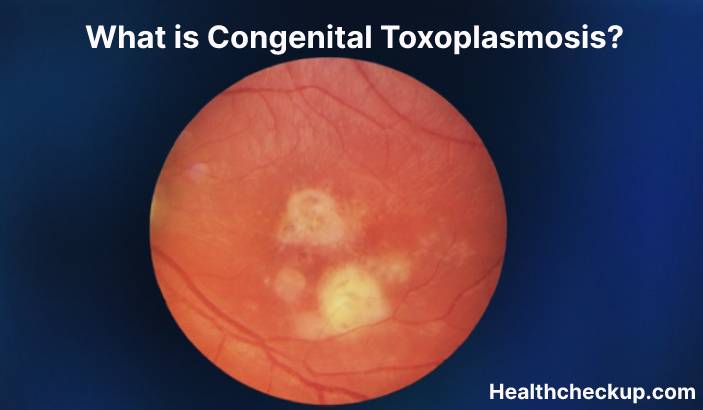 What is Congenital toxoplasmosis?