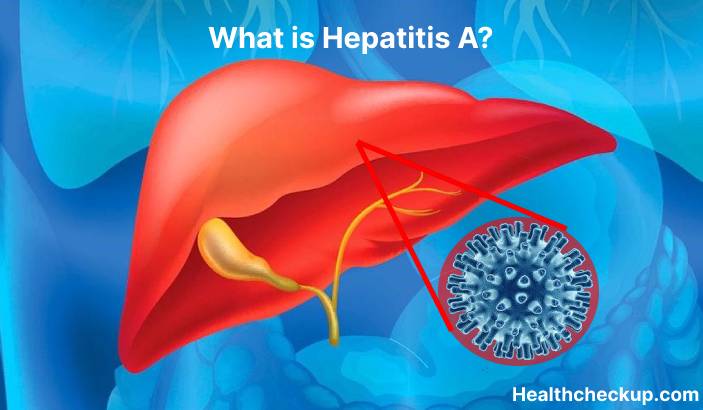 Hepatitis A - Symptoms, Diagnosis, Treatment, Prevention
