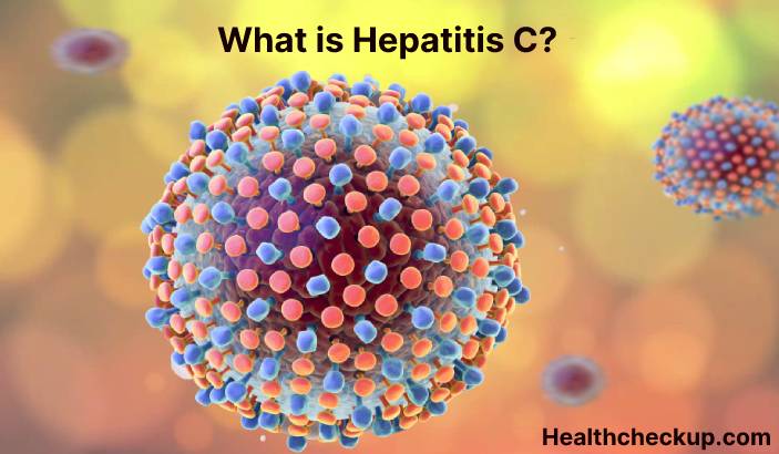 Hepatitis C - Symptoms, Diagnosis, Treatment, Prevention