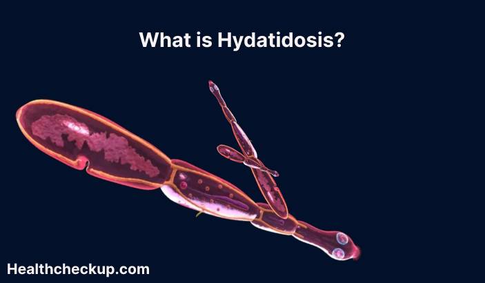 Hydatidosis - Symptoms, Treatment, Prevention