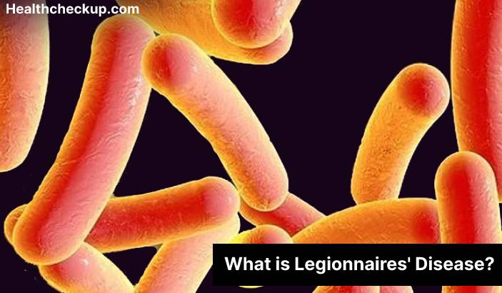 Legionnaires' disease - Symptoms, Diagnosis, Treatment, Prevention