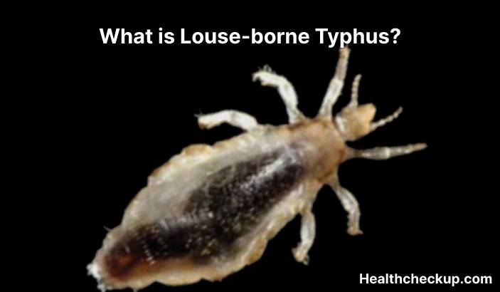 Louse-borne typhus - Symptoms, Diagnosis, Treatment, Prevention