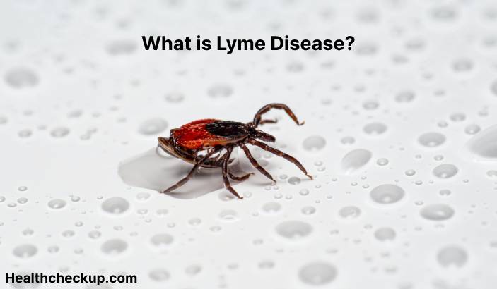 Lyme disease - Symptoms, Diagnosis, Treatment, Prevention