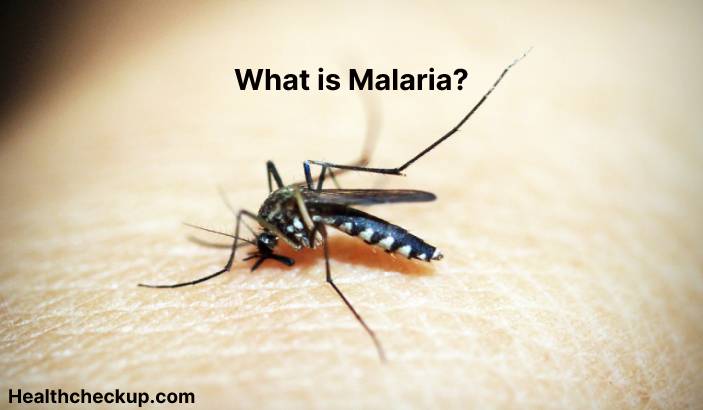 Malaria - Symptoms, Diagnosis, Treatment, Prevention