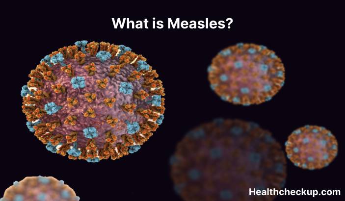 Measles - Symptoms, Diagnosis, Treatment, Prevention