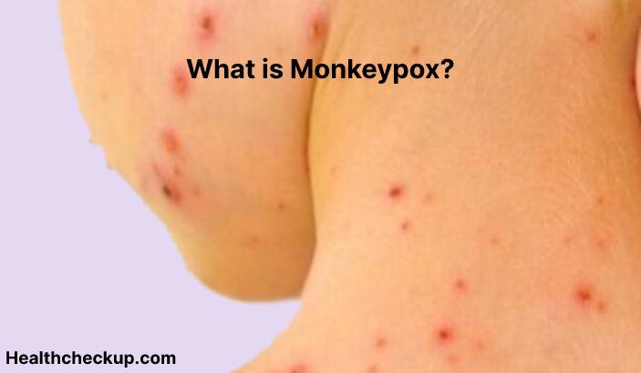 Monkeypox - Symptoms, Diagnosis, Treatment, Prevention