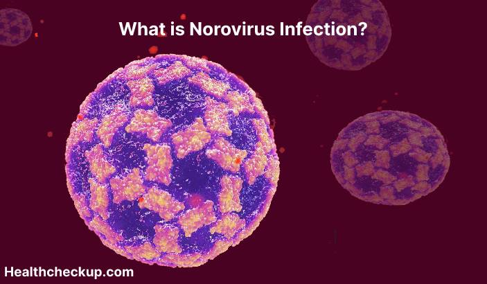 Norovirus Infection - Symptoms, Diagnosis, Treatment, Prevention
