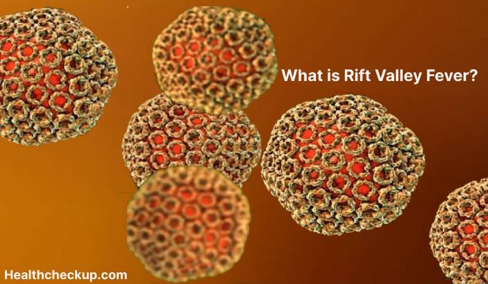 Rift Valley Fever - Symptoms, Diagnosis, Treatment, Prevention