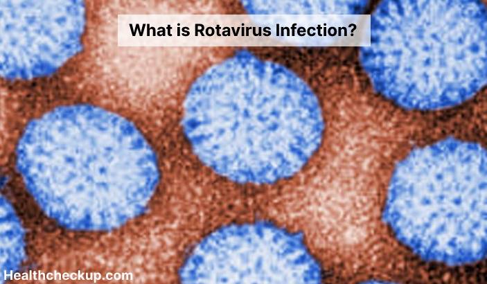 Rotavirus Infection - Symptoms, Diagnosis, Treatment, Prevention