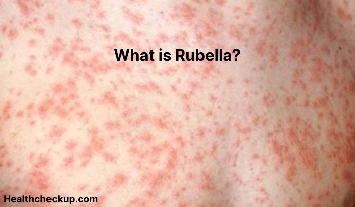 Rubella - Symptoms, Diagnosis, Treatment, Prevention