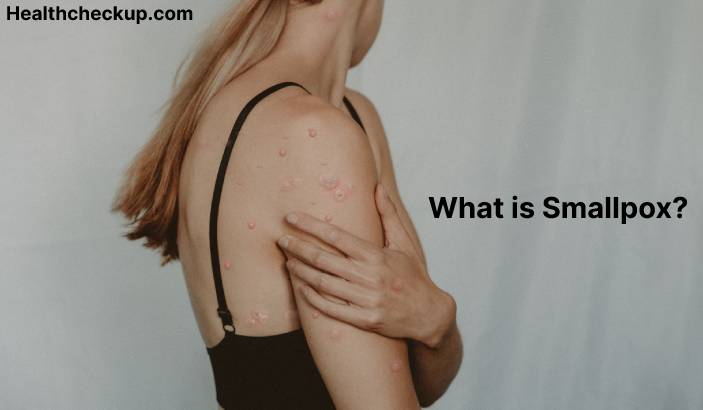 Smallpox - Symptoms, Diagnosis, Treatment, Prevention