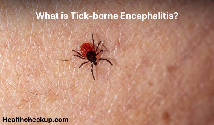 Tick-borne encephalitis (TBE) - Symptoms, Diagnosis, Treatment, Prevention