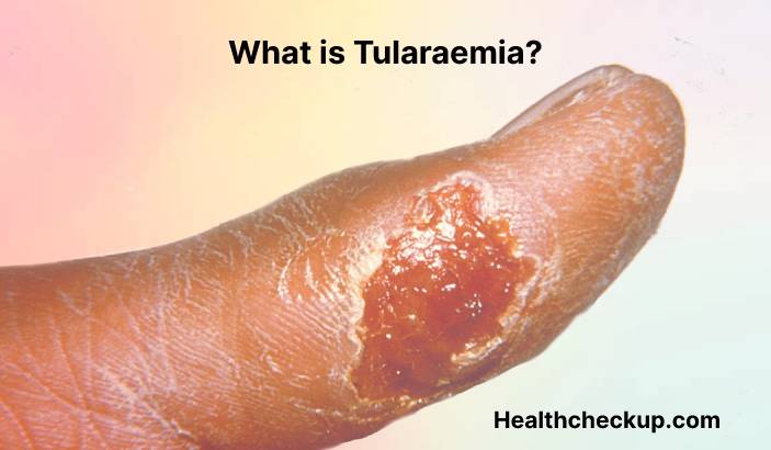 Tularaemia - Symptoms, Diagnosis, Treatment, Prevention