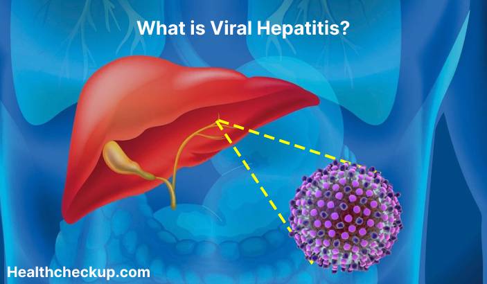 Viral hepatitis - Symptoms, Diagnosis, Treatment, Prevention