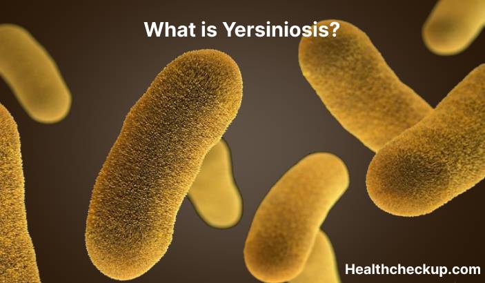 Yersiniosis - Symptoms, Diagnosis, Treatment, Prevention