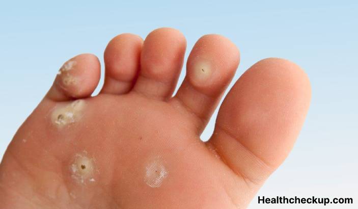 Cutaneous warts - Symptoms, Diagnosis, Treatment, Prevention