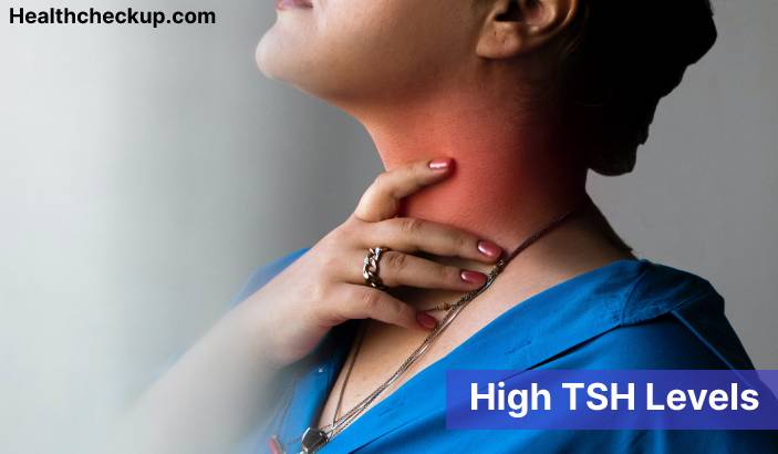 High TSH Levels - Symptoms, Causes & Treatment
