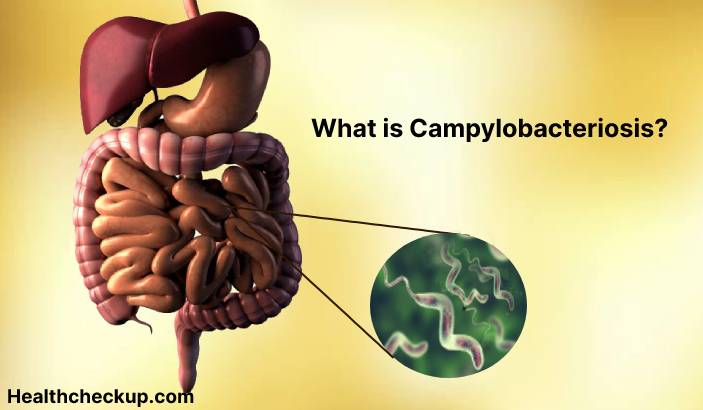 Campylobacteriosis - Symptoms, Diagnosis, Treatment, Prevention