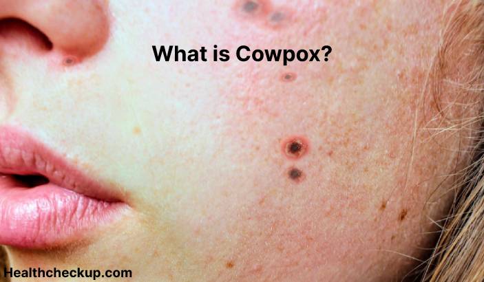 Cowpox - Symptoms, Diagnosis, Treatment, Prevention