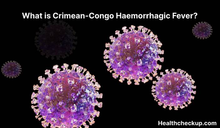 Crimean-Congo haemorrhagic fever (CCHF) - Symptoms, Diagnosis, Treatment