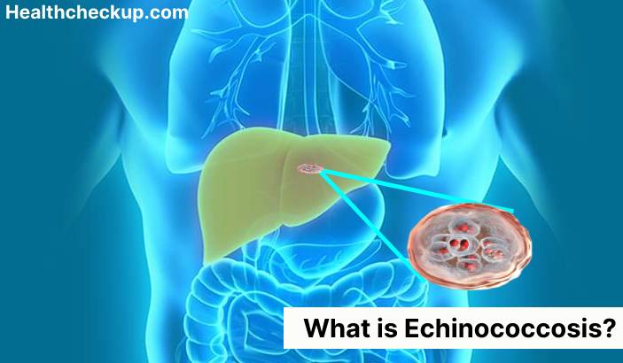 Echinococcosis - Symptoms, Diagnosis, Treatment, Prevention
