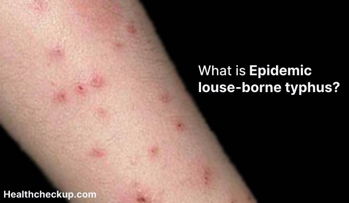 Epidemic louse-borne typhus - Symptoms, Diagnosis, Treatment, Prevention