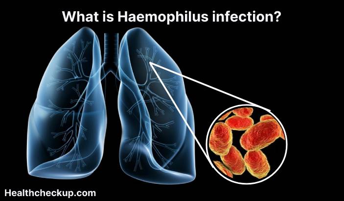 Haemophilus infection - TYpes, Symptoms, Diagnosis, Treatment