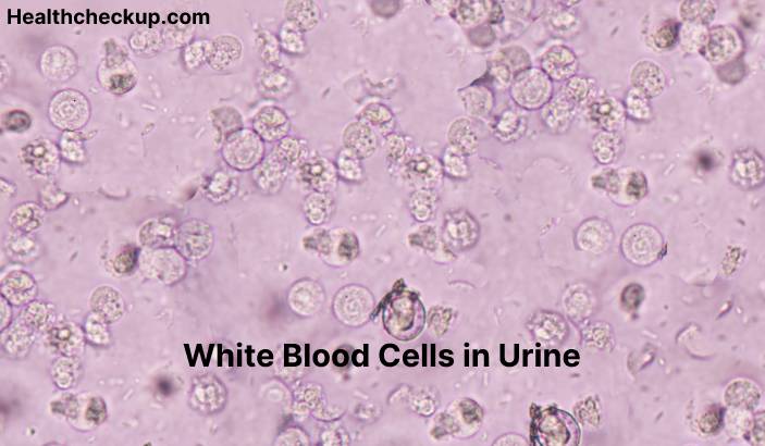 White Blood Cells in Urine - Causes, Diagnosis, Treatment