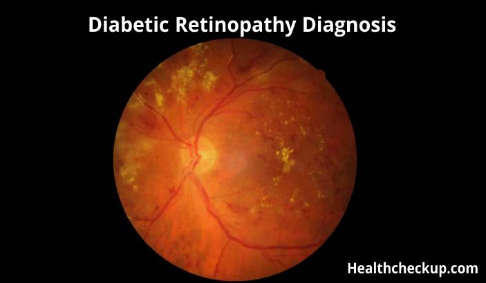 Diabetic Retinopathy - Diagnosis and Treatment Options