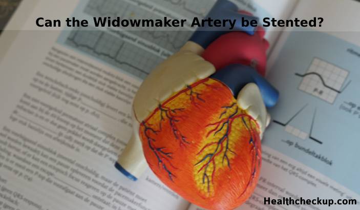 Can the Widowmaker Artery be Stented?