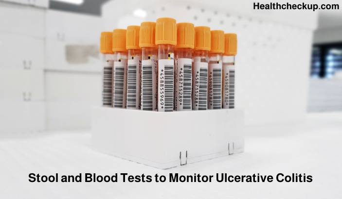 Stool and Blood Tests to Monitor Ulcerative Colitis