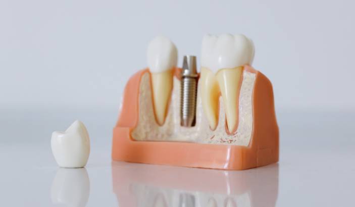 Why Dental Implants Are Better Than Dentures