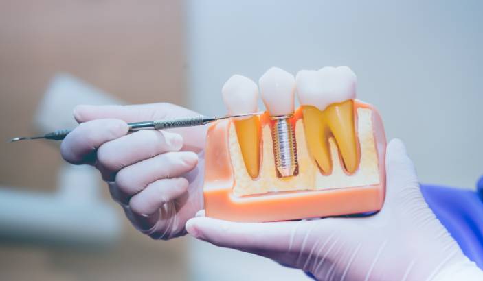 A Quick Guide To The Dental Implant Process