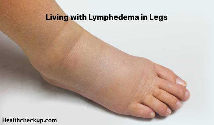 : Lymphedema in Legs: Causes, Symptoms, and Treatment