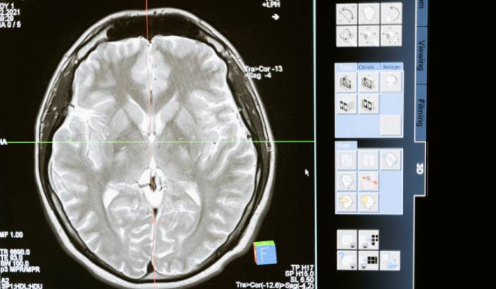 Long Term Effects of a Brain Injury