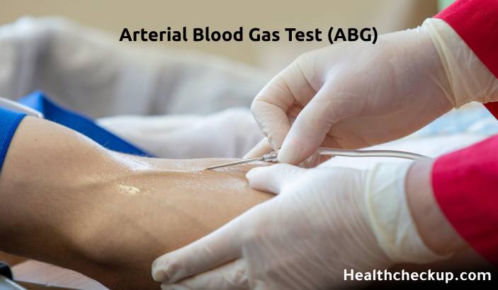 What is an Arterial Blood Gas (ABG) Test?