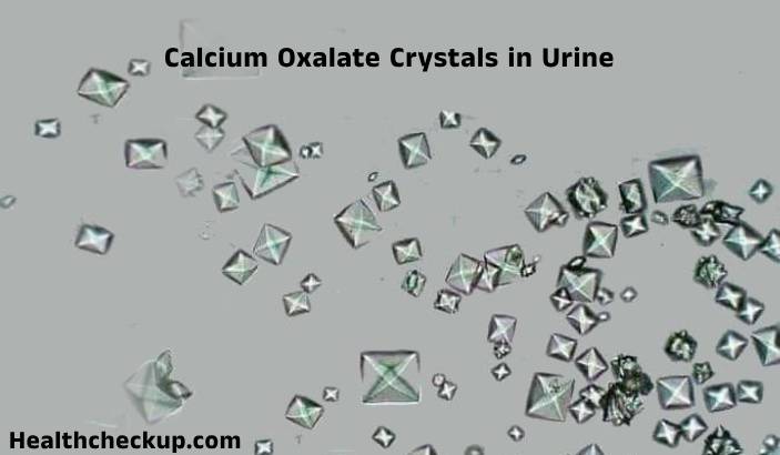 Calcium Oxalate Crystals in Urine: Causes, Diagnosis, Normal Range, and Treatment