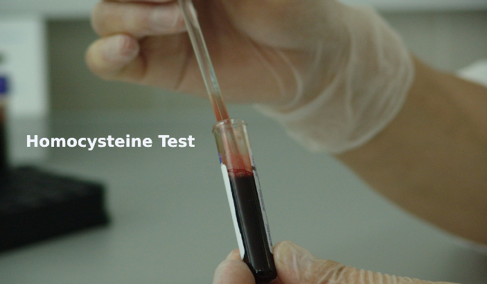 Homocysteine Test